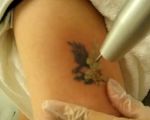 Laserowe usuwanie tatuażu